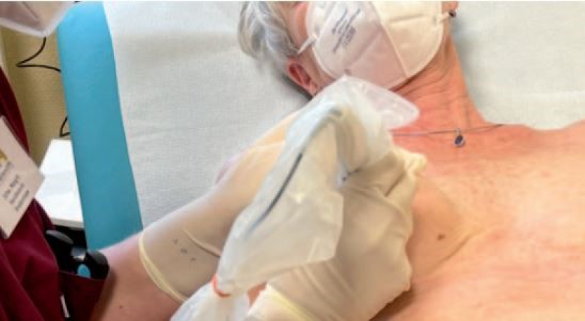 Auf dem Fotoausschnitt erkennen Sie, wie per Mikropegmentierung Frauen nach einer Brustkrebserkrankung eine Brustwarze nachgebildet wird.
